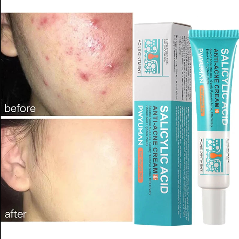 Salicylic Acid Acne Treatment Cream